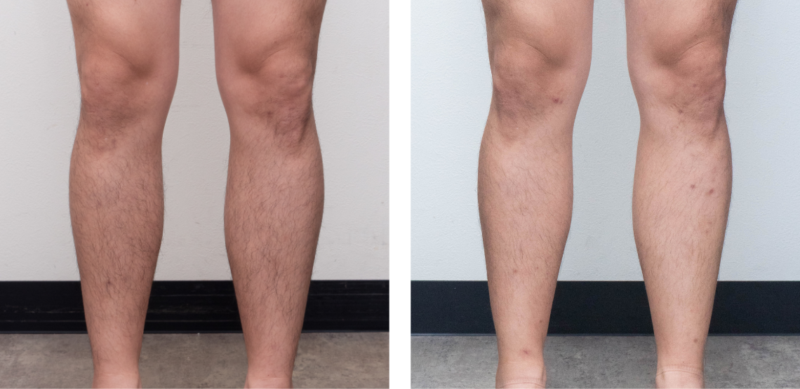 ちゃんと減るをこの料金で。効果、第一主義ゴリラの医療ヒゲ脱毛