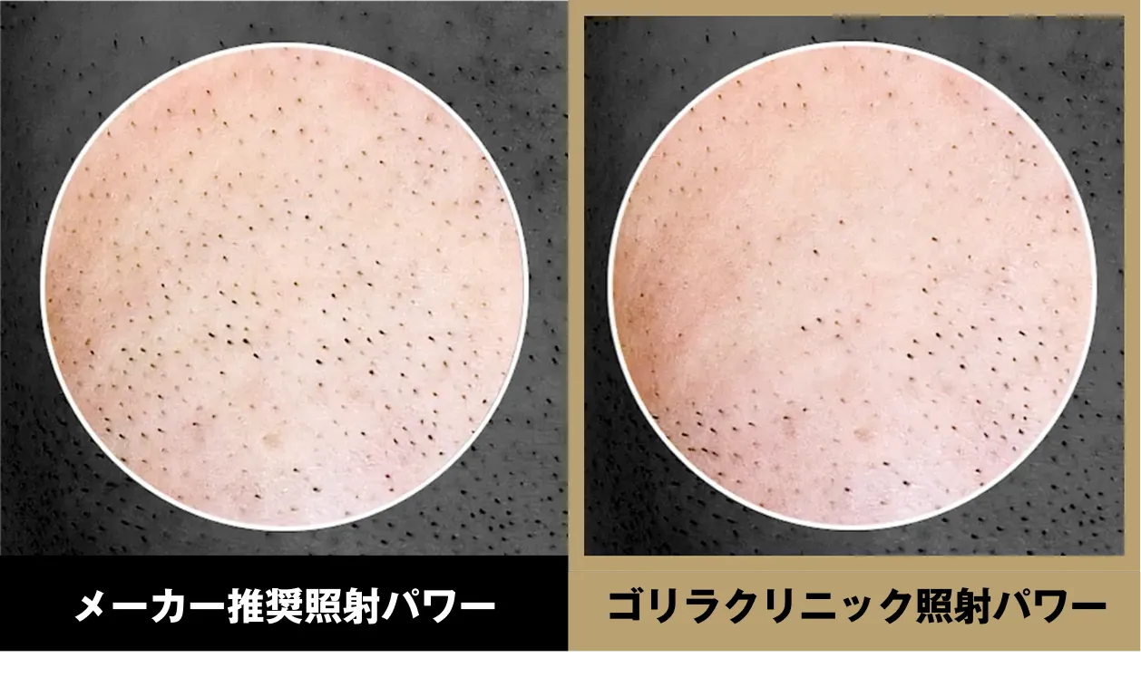 メーカー推奨照射パワーとゴリラクリニック照射パワーの比較