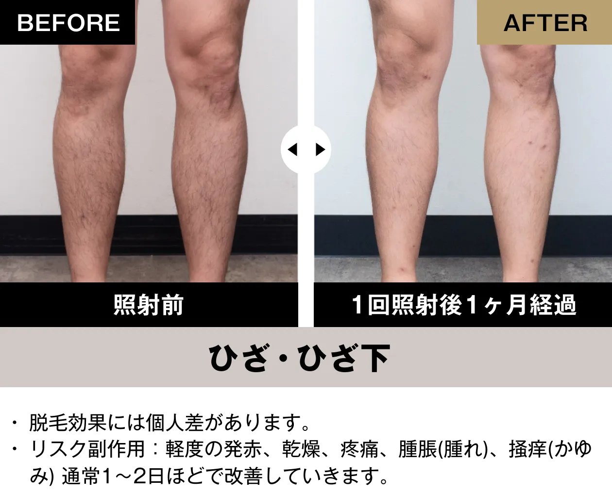 ひざ・ひざ下の脱毛ビフォーアフター