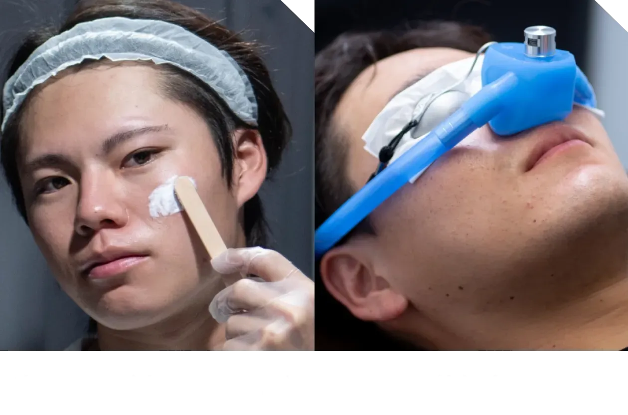 表面麻酔（麻酔クリーム）／笑気麻酔