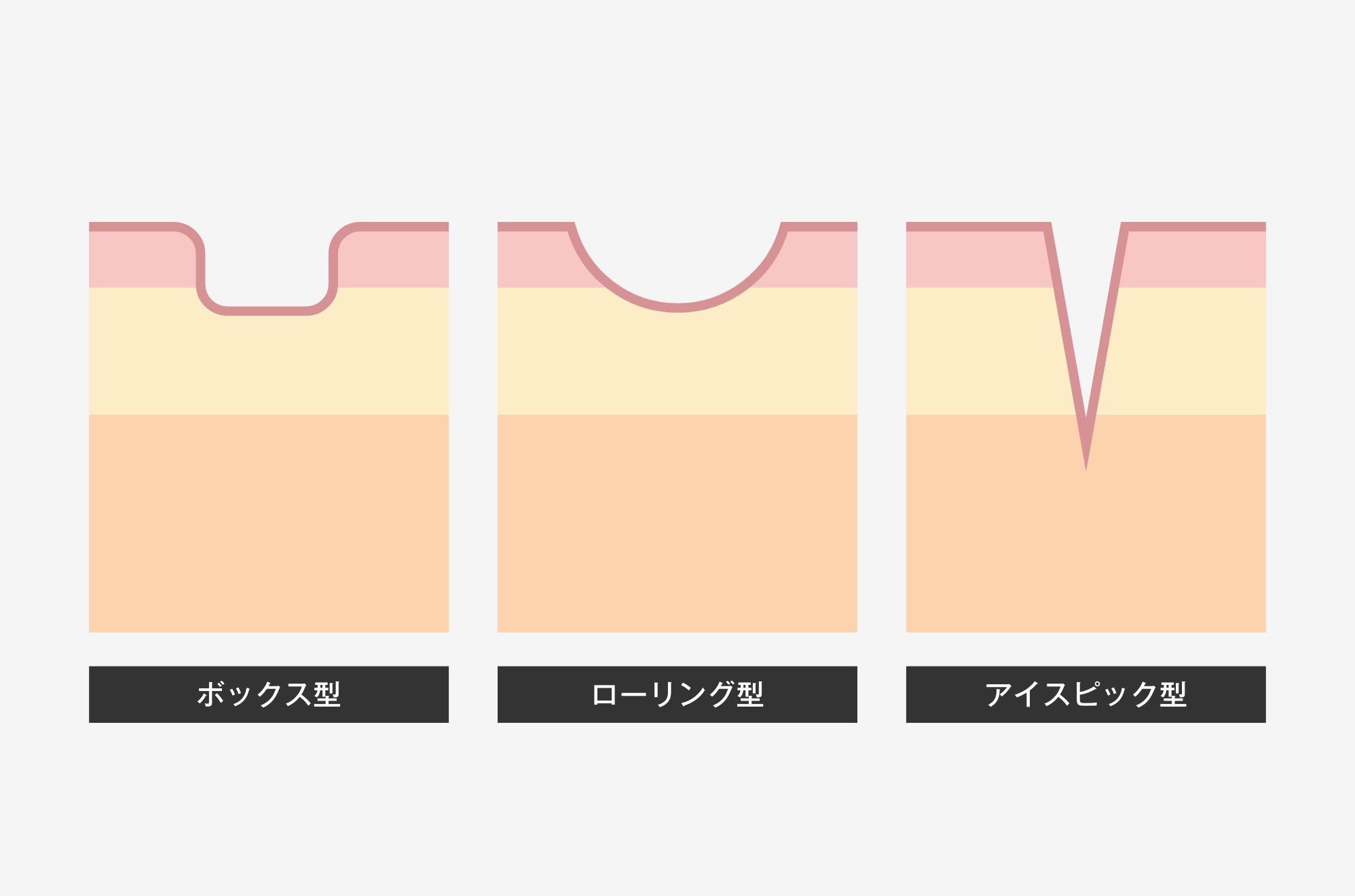 ニキビ跡の凹み（クレーター）の種類と特徴