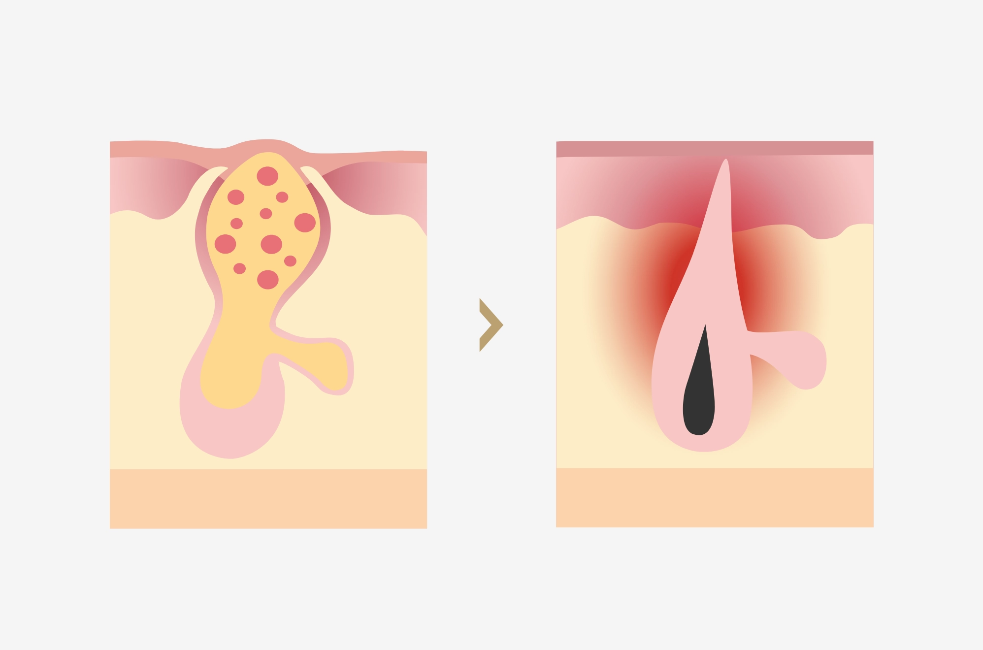 ニキビ跡の赤みとは