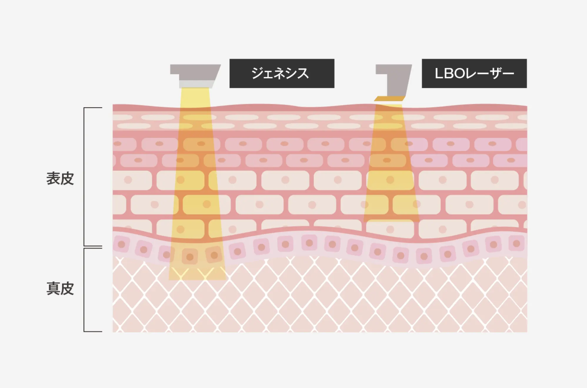 ニキビ跡の赤み治療の仕組み