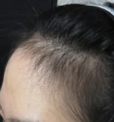 施術後