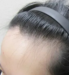 施術前