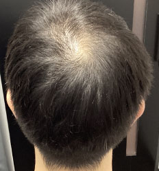 施術前