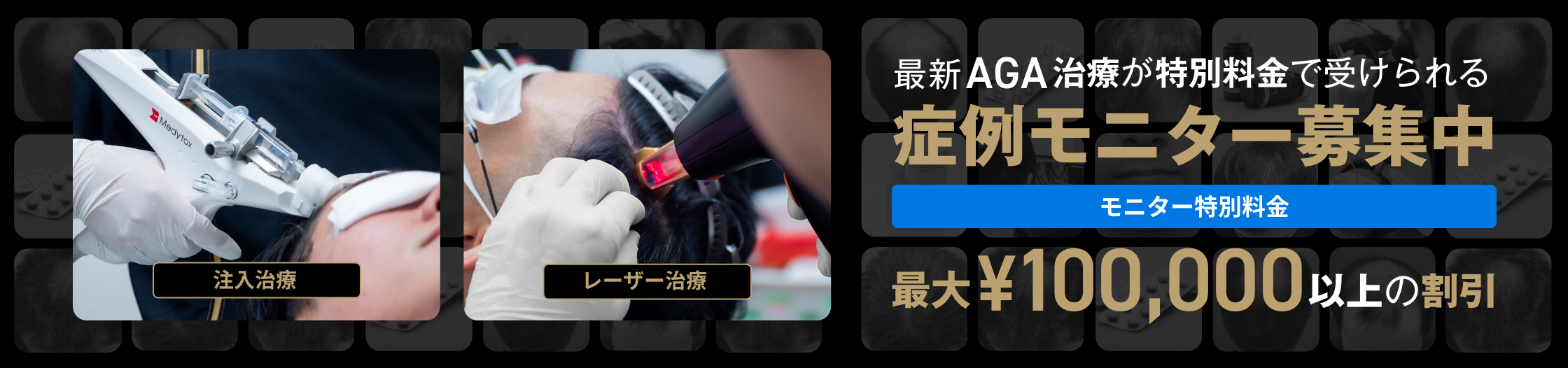最新のAGA治療が特別料金で受けられる。症例モニター募集中。最大¥100,000以上の割引。