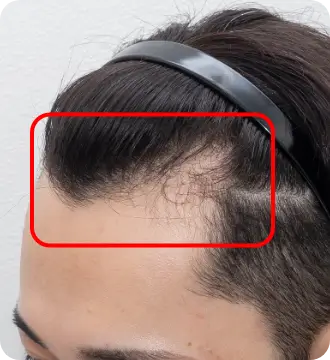 Folixレーザー治療 生え際（M字部分）の経過 施術前