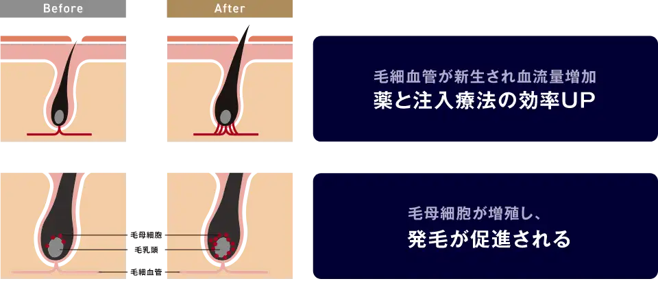 Folixレーザー治療の特徴