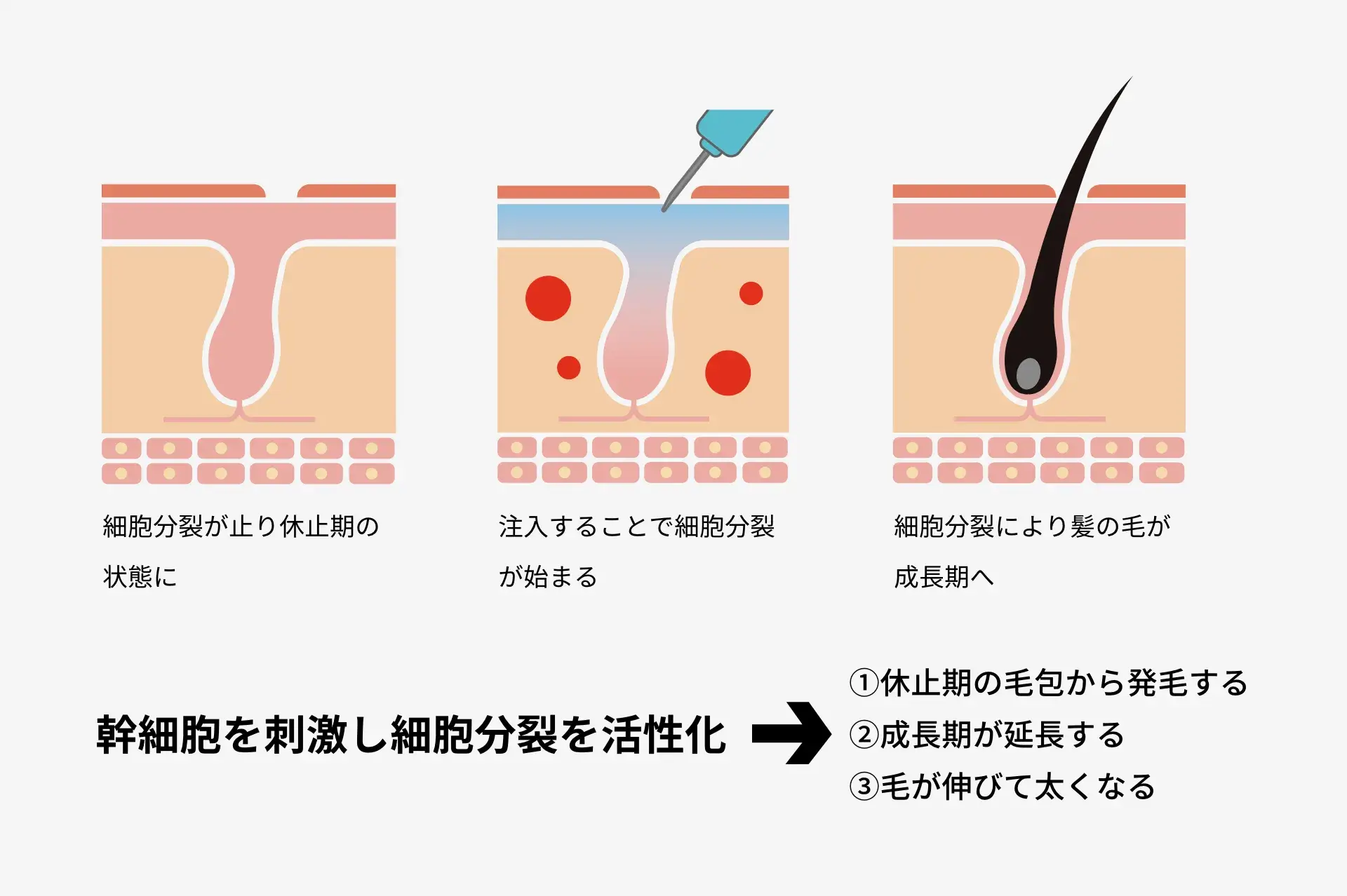 AGA注入治療の効果