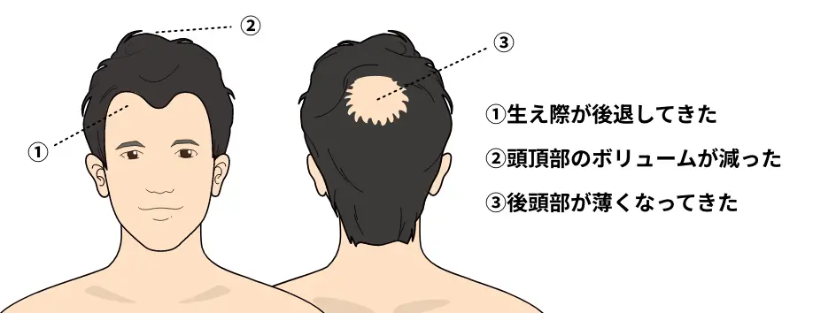進行状態の目安①生え際が後退してきた②頭頂部のボリュームが減った③後頭部が薄くなってきた