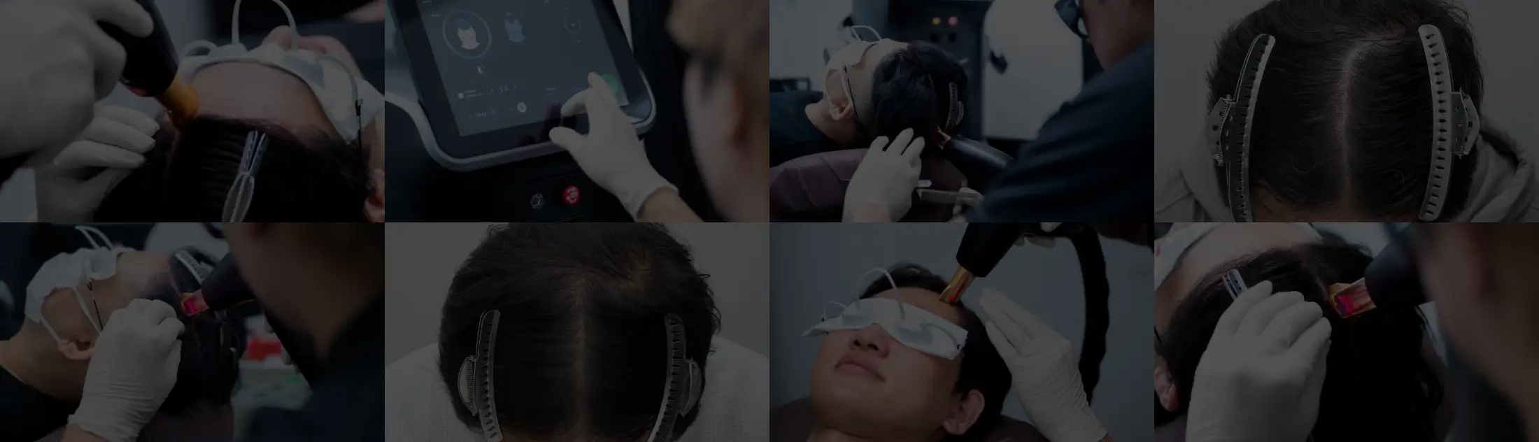 フォリックスレーザー治療の様子