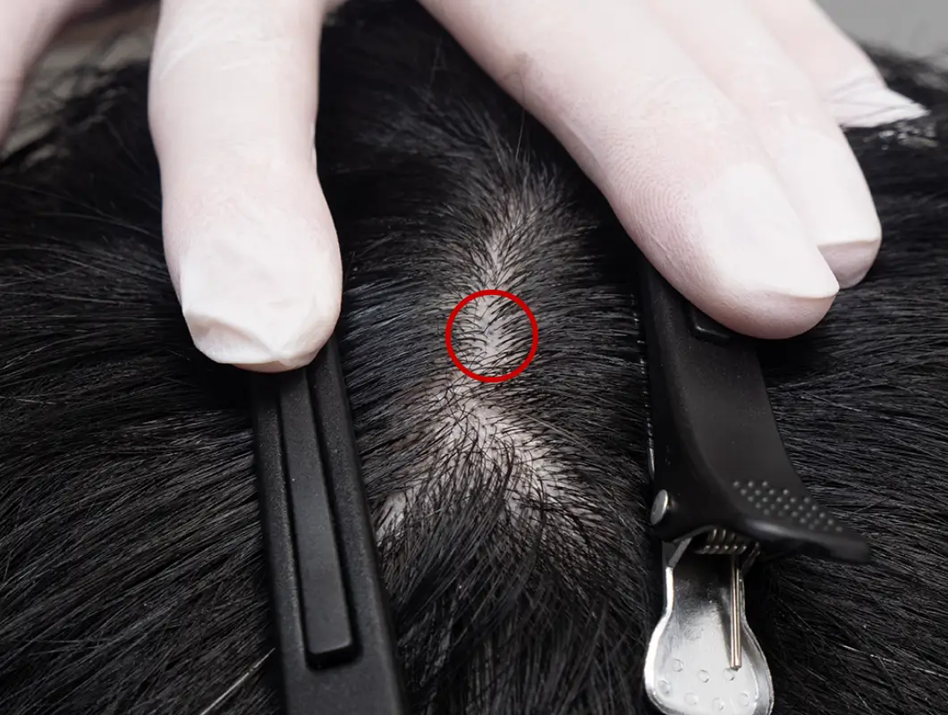 マーキング後の頭皮