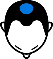 生え際が後退している
