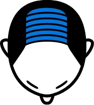 地肌が目立つようになった