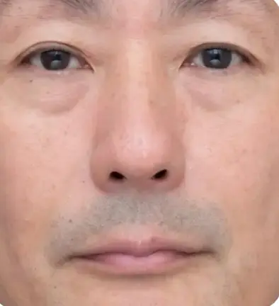 エイジングケア治療After