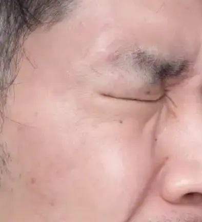エイジングケア治療After