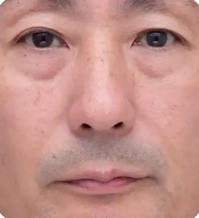 エイジングケア治療Before