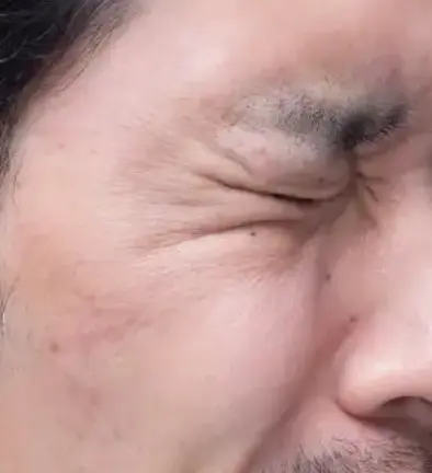 エイジングケア治療Before