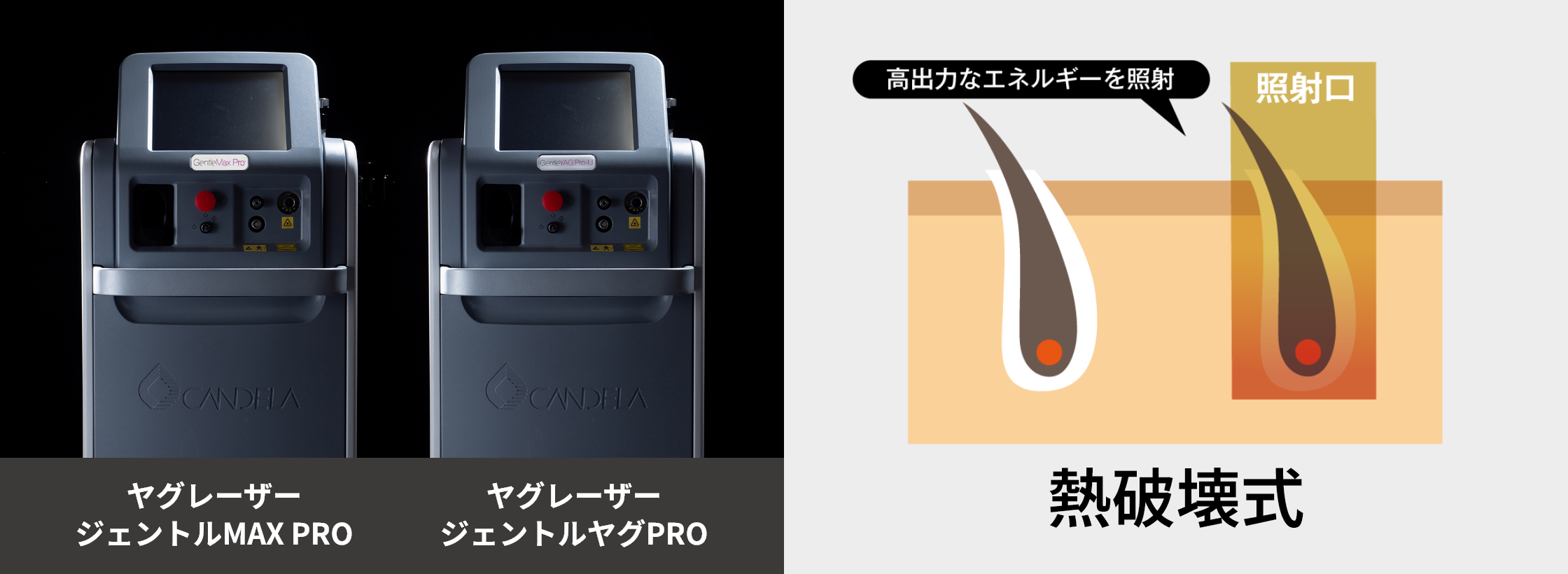 ヤグレーザージェントルMAX PRO、ヤグレーザージェントルヤグPRO、熱破壊式
