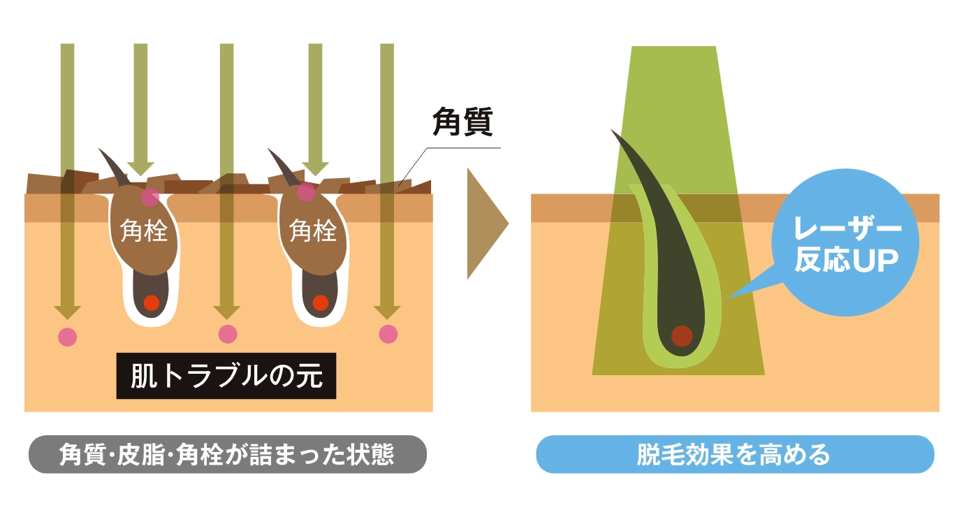 2種類の医療用麻酔
