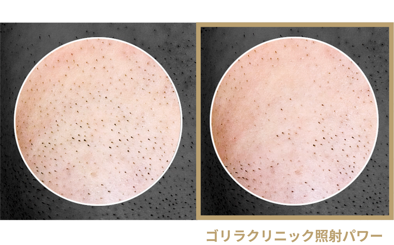 脱毛効果最大化