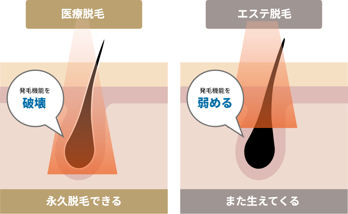 医療脱毛：永久脱毛できる、エステ脱毛：また生えてくる