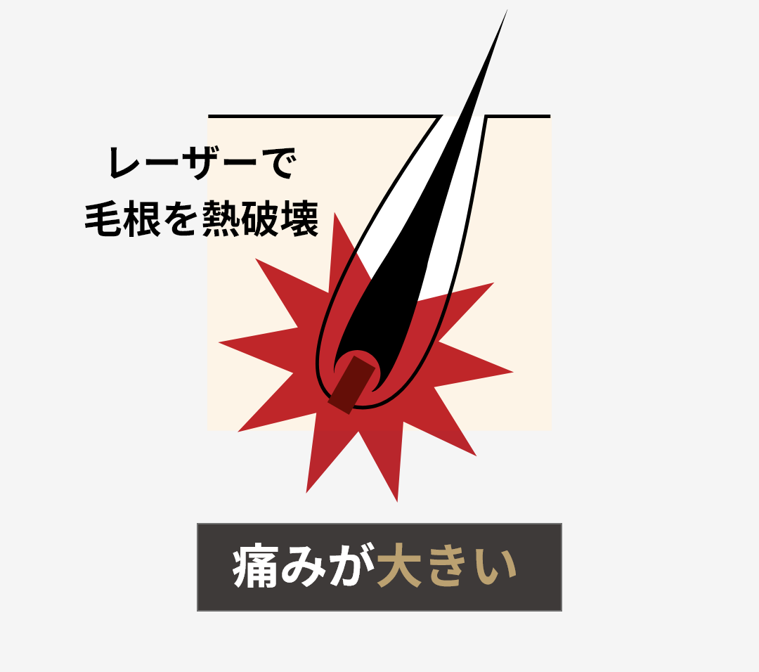 レーザーで毛根を熱破壊 痛みが大きい