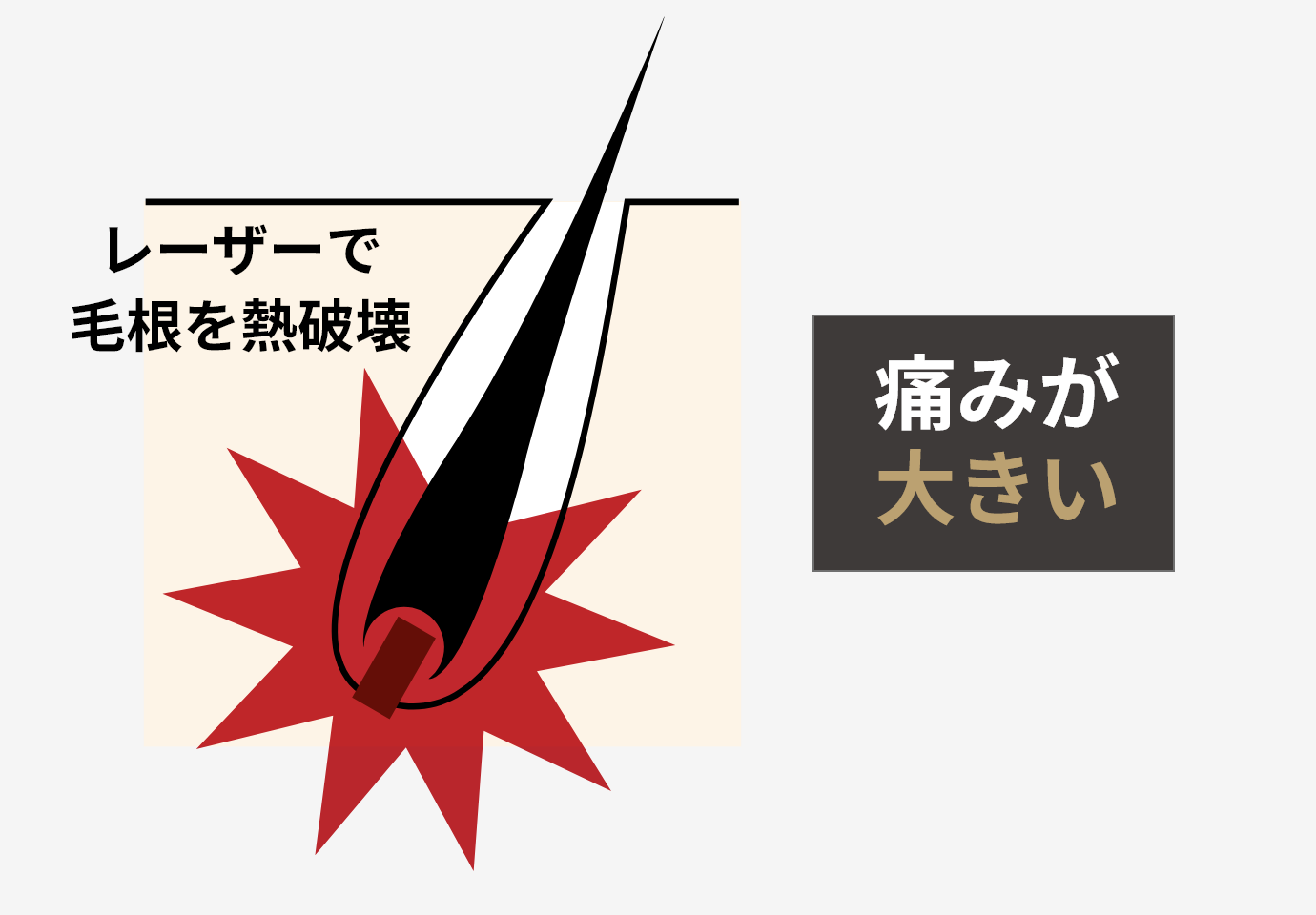 レーザーで毛根を熱破壊 痛みが大きい