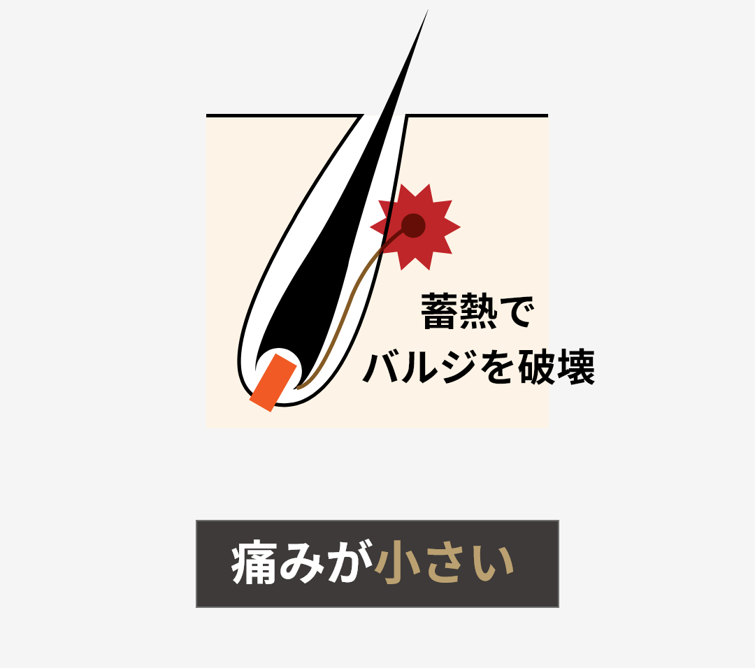 蓄熱でバルジを破壊 痛みが小さい