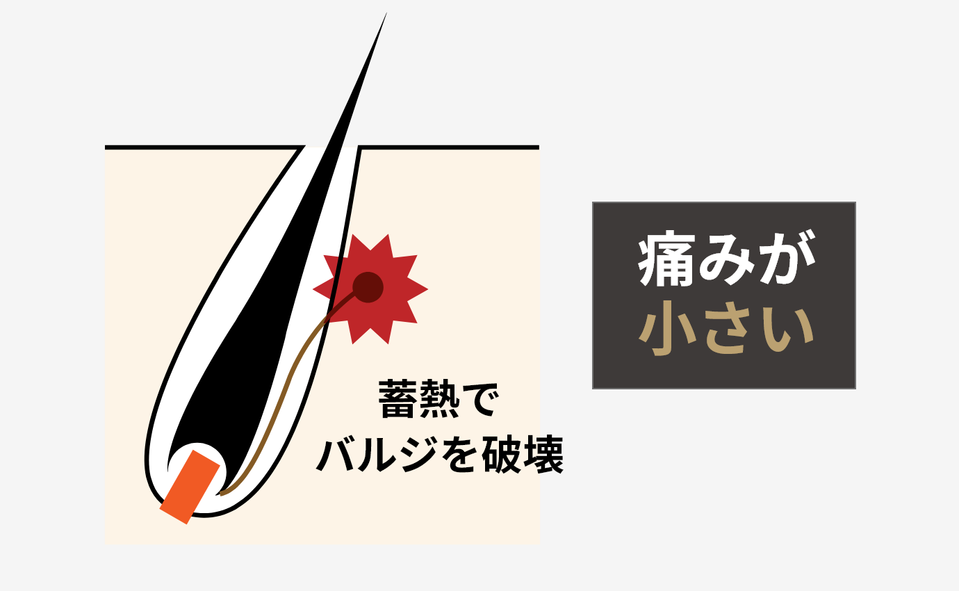蓄熱でバルジを破壊 痛みが小さい