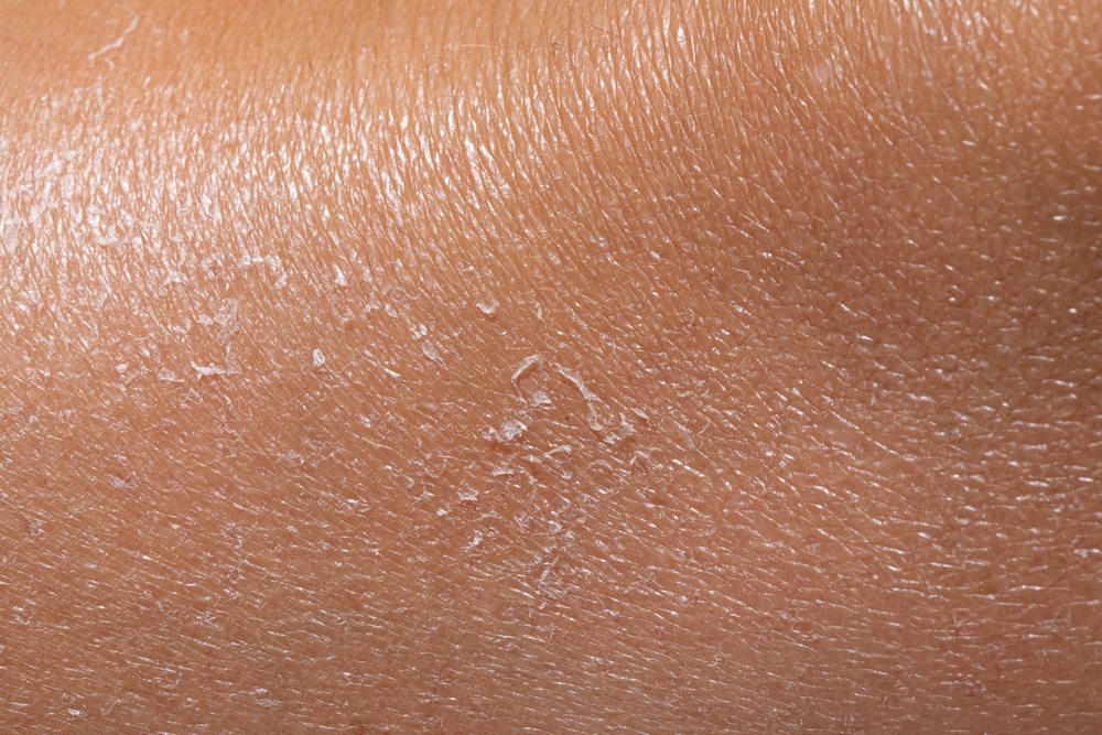 Dry,Skin,Peeling,And,Flaking,,Indicating,Severe,Dehydration,And,Potential