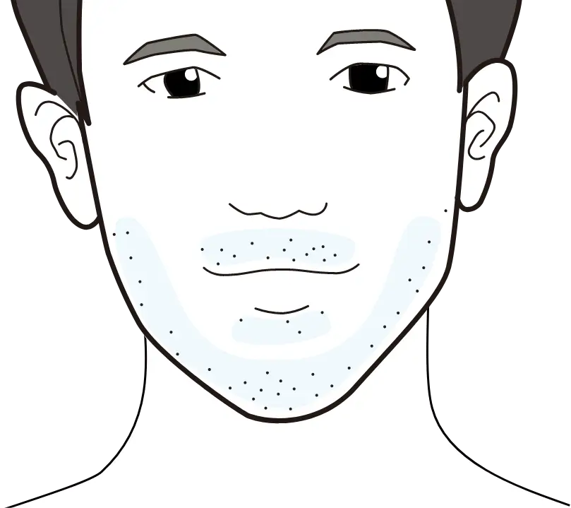 一般的なクリニックの脱毛効果