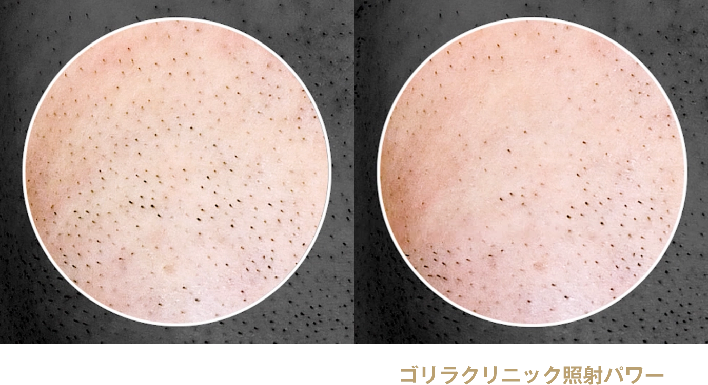 メーカー推奨照射パワー　ゴリラクリニック照射パワー