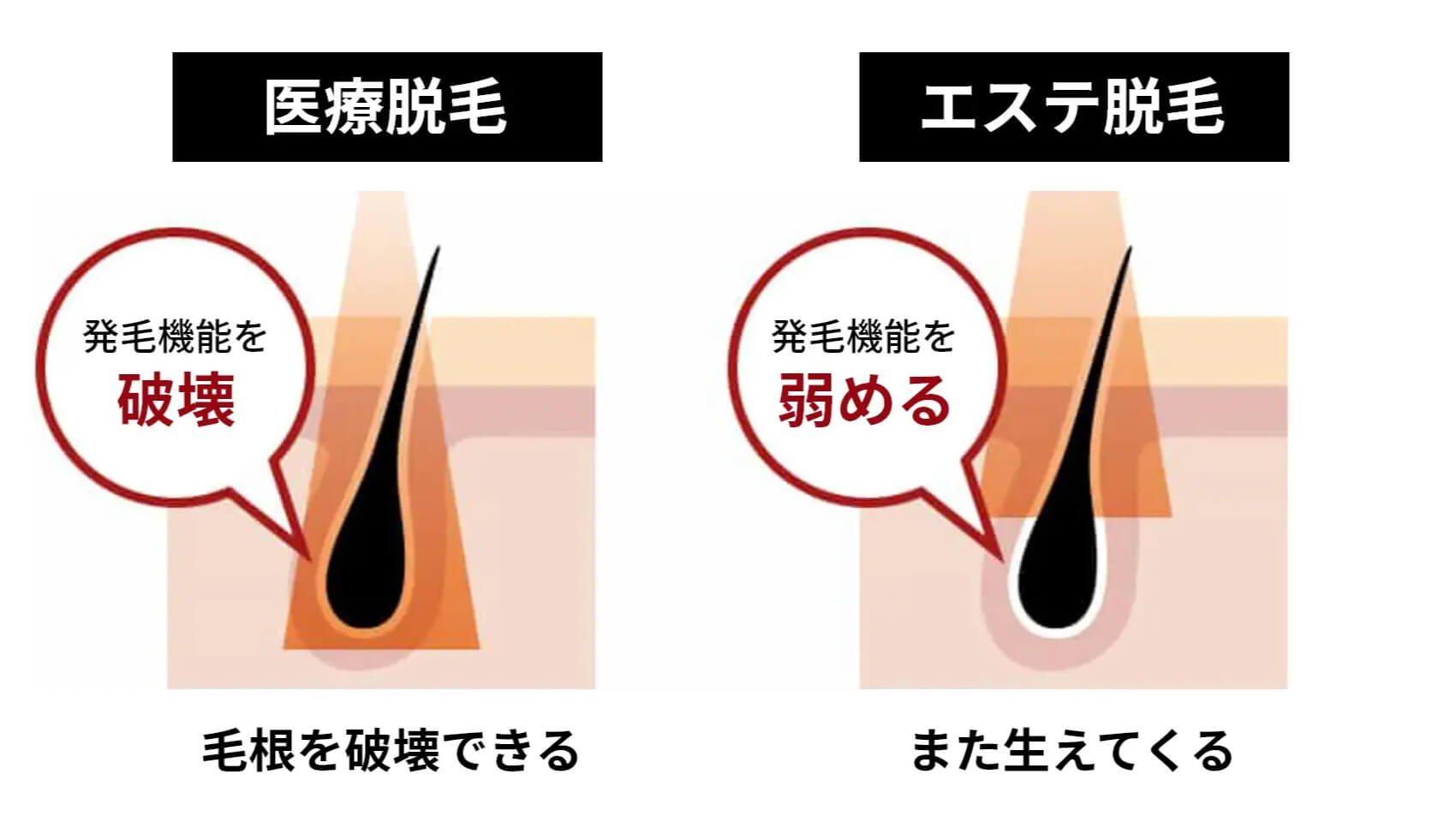 エステ脱毛イラスト