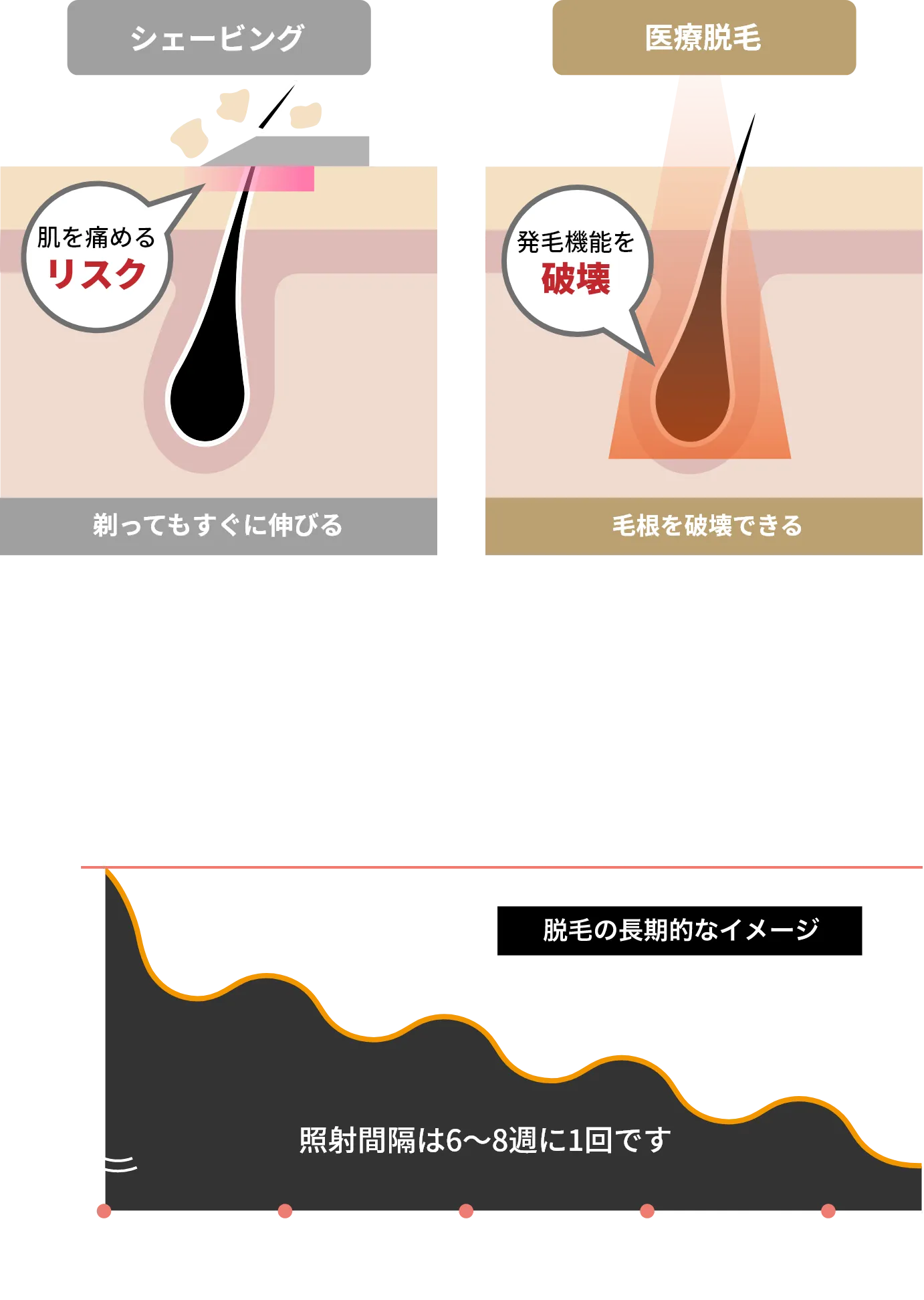 イラスト：シェービングと医療脱毛の比較