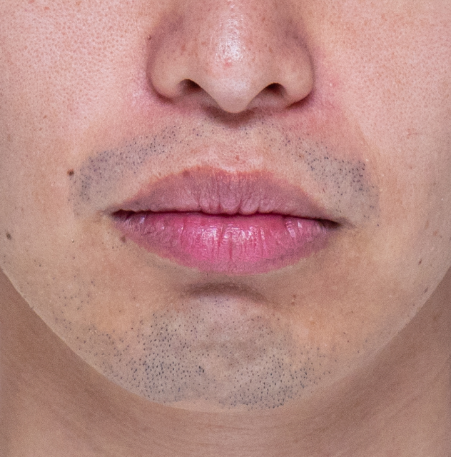 夜になるとヒゲが伸び余計に目立つ