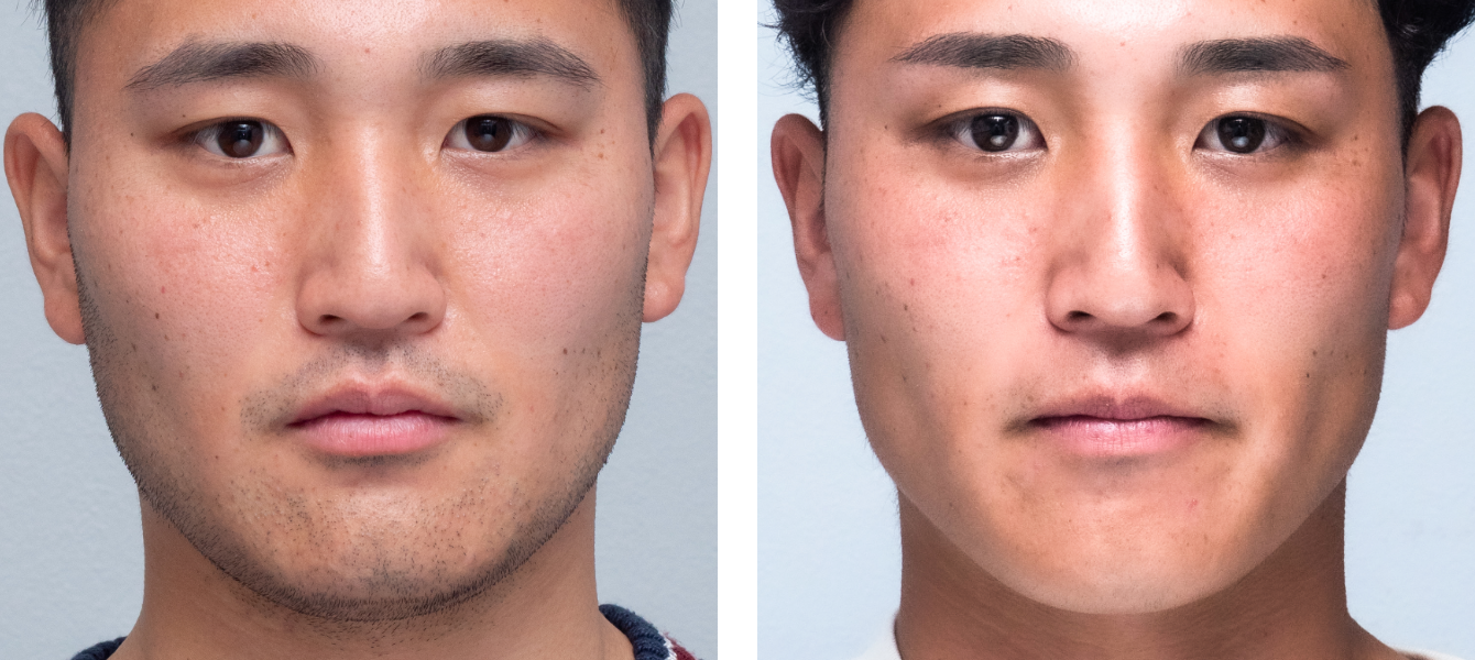 脱毛前、回脱毛後