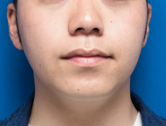 症例1 ヒゲ脱毛 顔正面 施術後