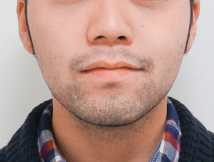 症例1 ヒゲ脱毛 顔正面 施術前