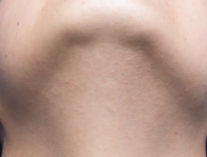 症例1 ヒゲ脱毛 アゴ下 施術後