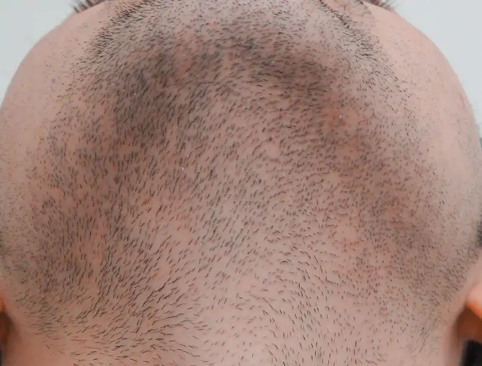 症例1 ヒゲ脱毛 アゴ下 施術前