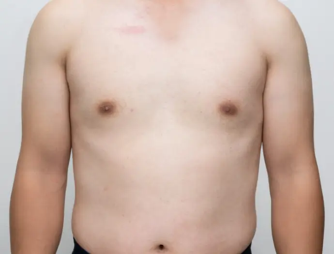 症例2 ボディ脱毛 胸・腹 施術後