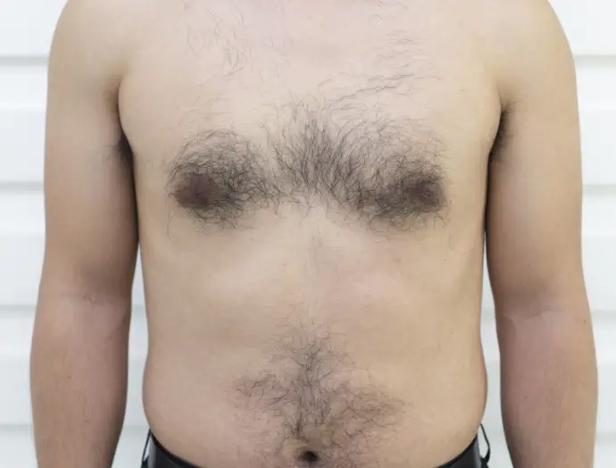 症例2 ボディ脱毛 胸・腹 施術前