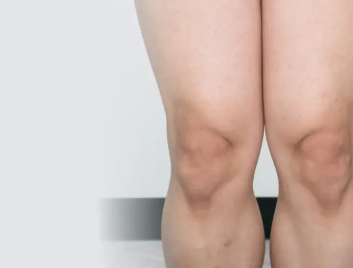 症例2 ボディ脱毛 太もも・ひざ・ひざ下 施術後