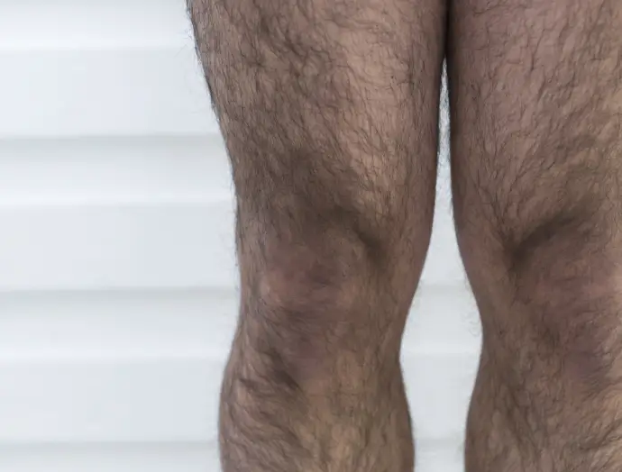 症例2 ボディ脱毛 太もも・ひざ・ひざ下 施術前