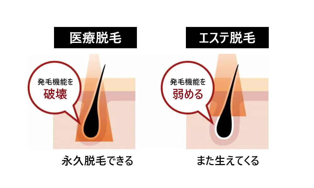 医療脱毛、エステ脱毛