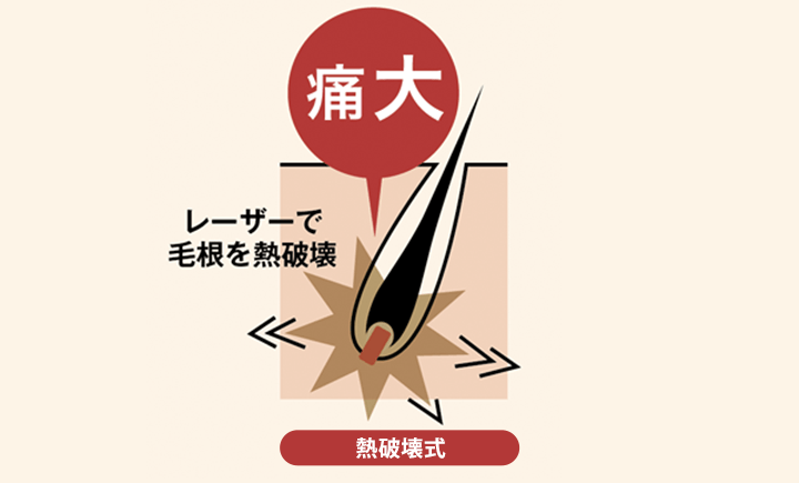 メンズの医療レーザー脱毛の機械はどれがいい?脱毛の種類から メンズの医療レーザー脱毛の機械はどれがいい?脱毛の種類から