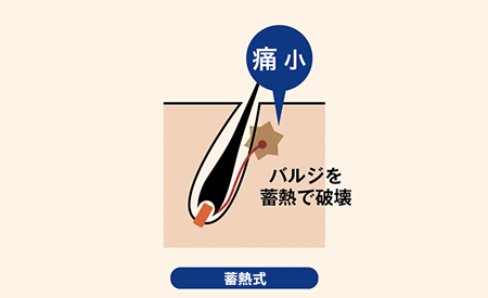 蓄熱式脱毛の様子