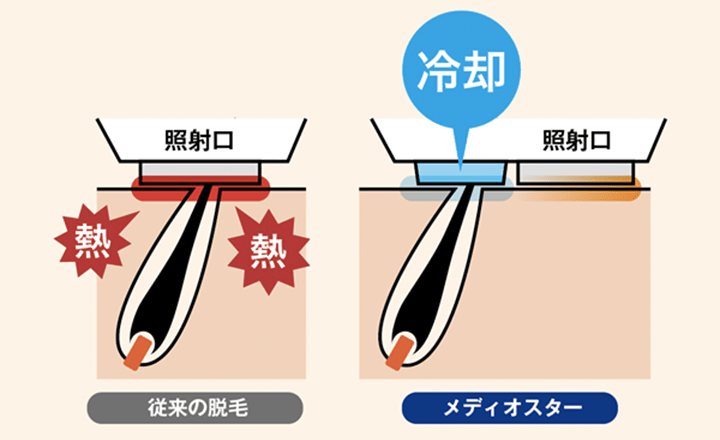 「メディオスター NeXT PRO」のメリット2 冷却装置